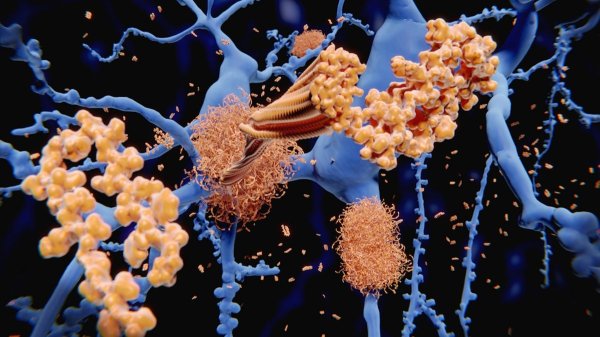 Two cancer drugs show promise in reversing Alzheimer's devastating effects Two cancer drugs show promise in reversing Alzheimer's devastating effects