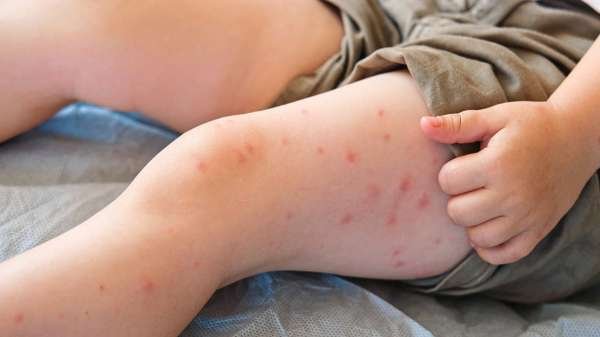 Measles outbreak poses risk of 'irreversible' brain damage, health officials warn