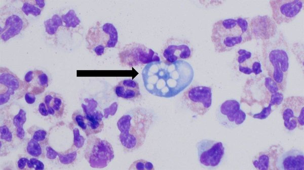 Teen dies from ‘brain-eating amoeba’ just days after young girl succumbs to same rare infection Teen dies from ‘brain-eating amoeba’ just days after young girl succumbs to same rare infection